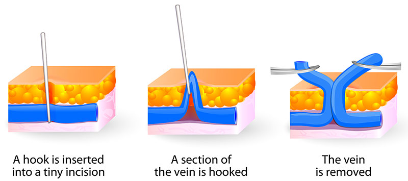 A diagram showing the ambulatory micro-phlebectomy.