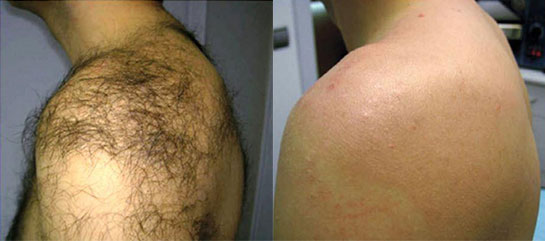Before and after laser hair removal on back hair
