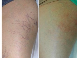 Before and after spider vein removal