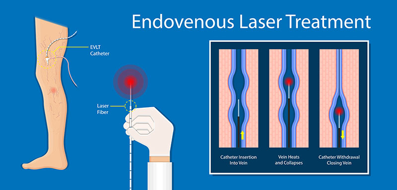 Illustration showing the endovenous laser treatment process.