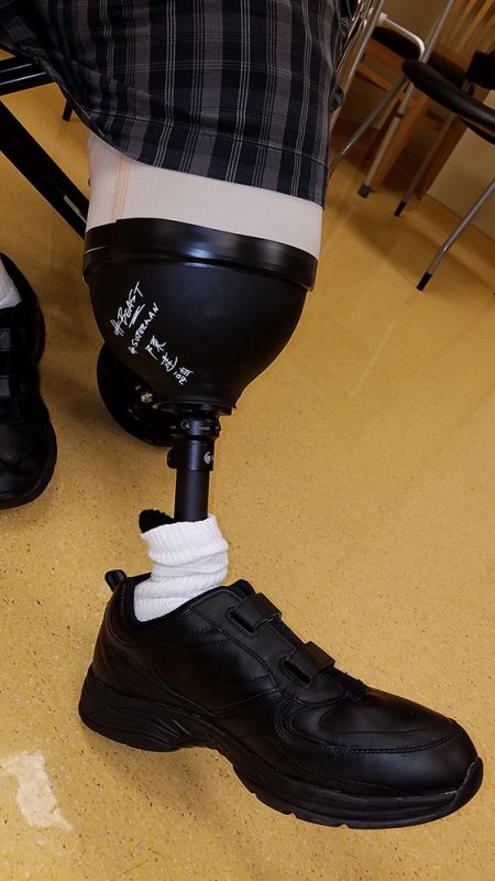 Custom Prosthetic Design - Vascular Surgical Associates