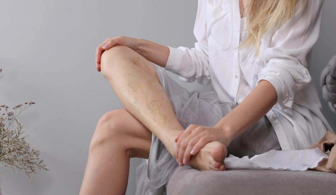 Woman holding leg with spider veins