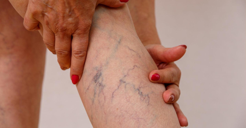 Noticing More Visible Varicose and Spider Veins as You Age? Here’s How You Can Treat Them Ahead of the Summer Months