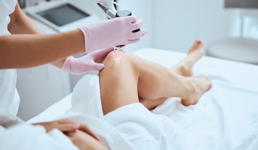 Can You Get Rid of Cosmetic Veins?