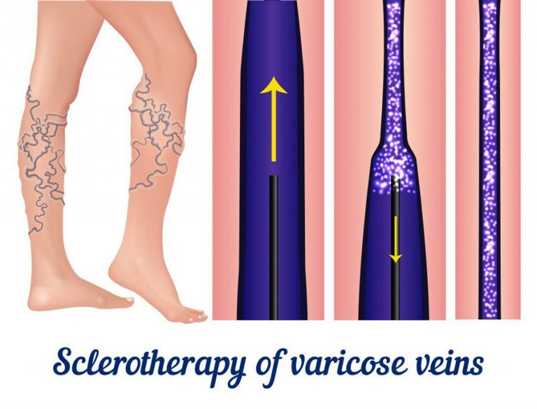 Illustration of Sclerotherapy process in legs with varicose veins.