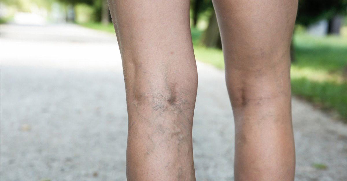 Varicose veins on the bag of a female’s legs.