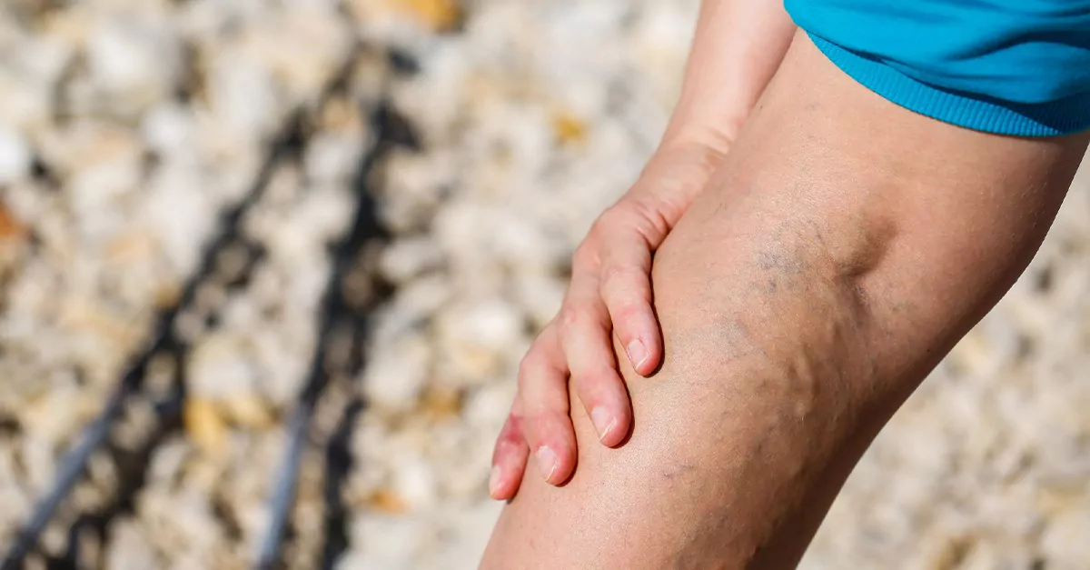 How Hot Weather Affects Your Veins and Blood Flow